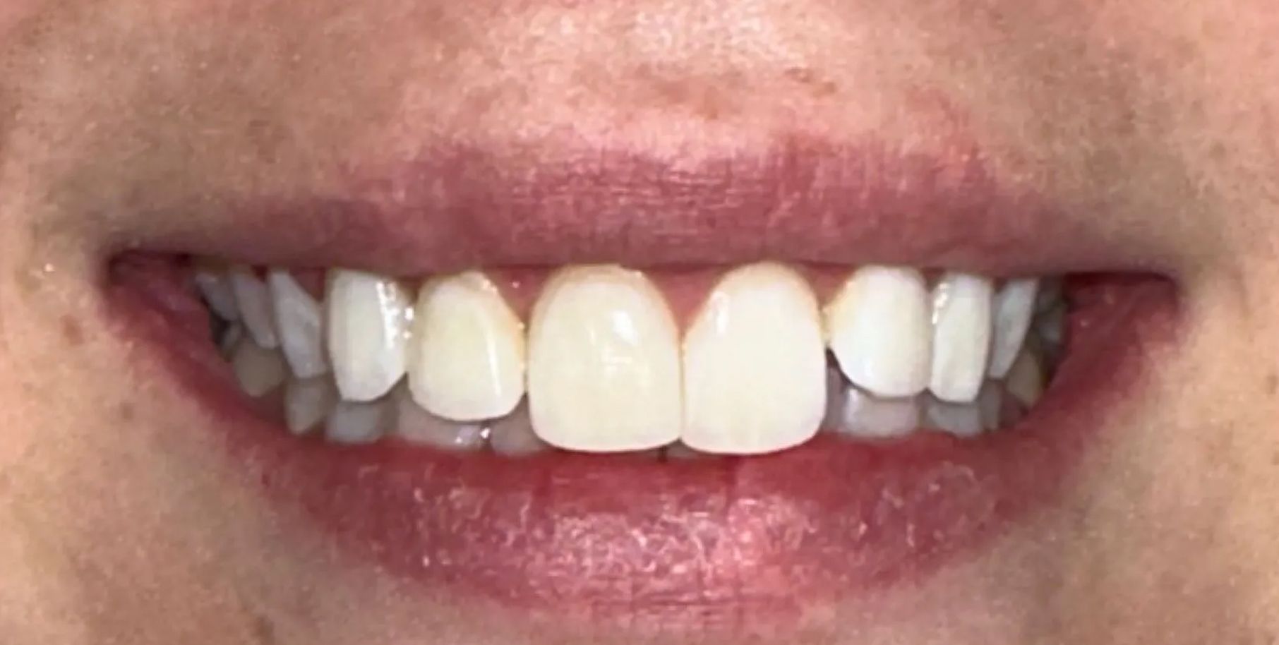 A close up of a person 's mouth with white teeth.