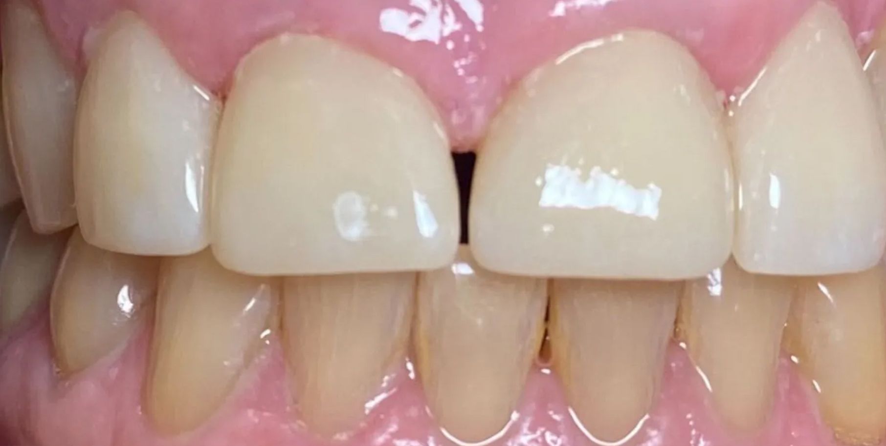 A close up of a person 's teeth with a missing tooth.