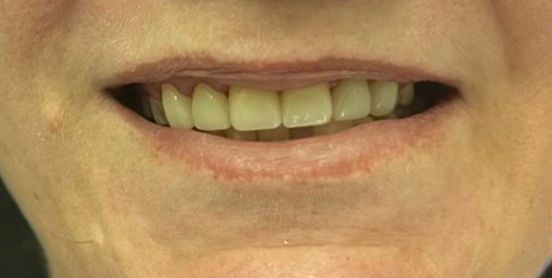 A close up of a woman 's mouth with her teeth showing.