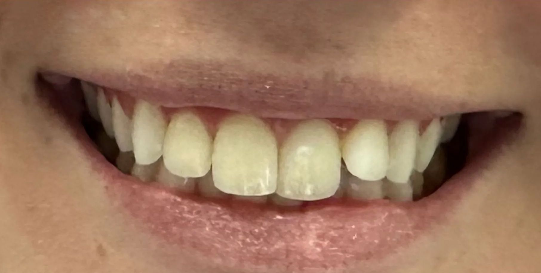A close up of a person 's mouth with white teeth.