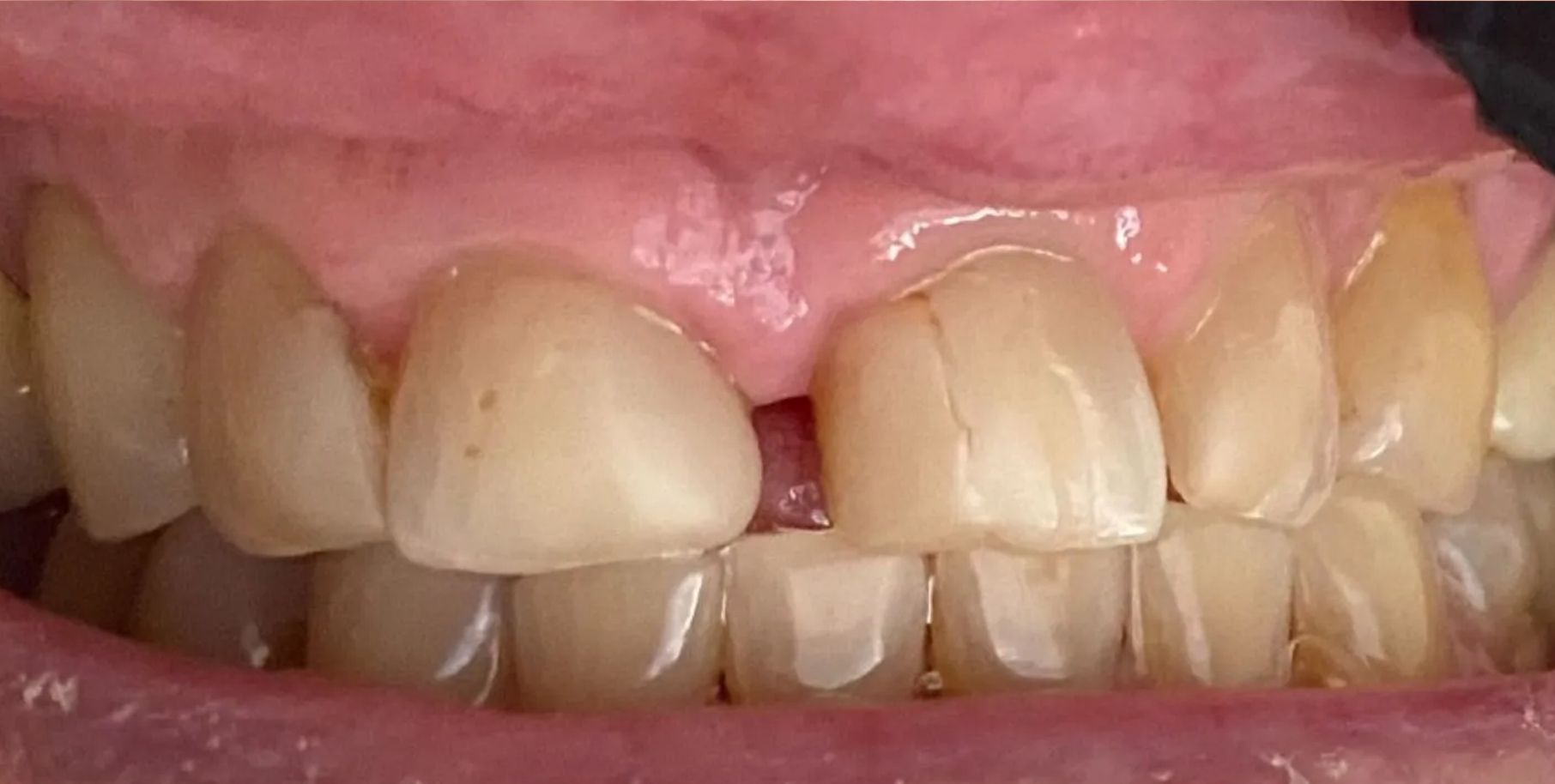 A close up of a person 's teeth with a broken tooth.