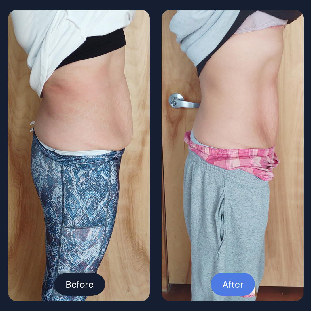 Comparison of woman's side profile before and after. Showing reduction in waist size, wearing athletic pants and sweatpants.