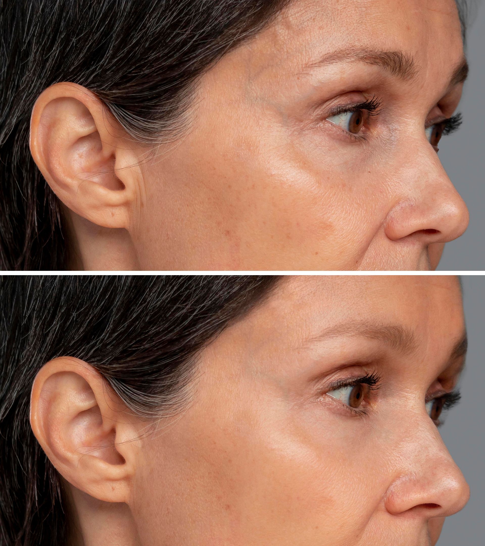 A man is getting a laser treatment on his face.
