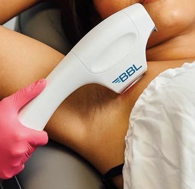 A woman is getting a laser hair removal treatment on her underarm.