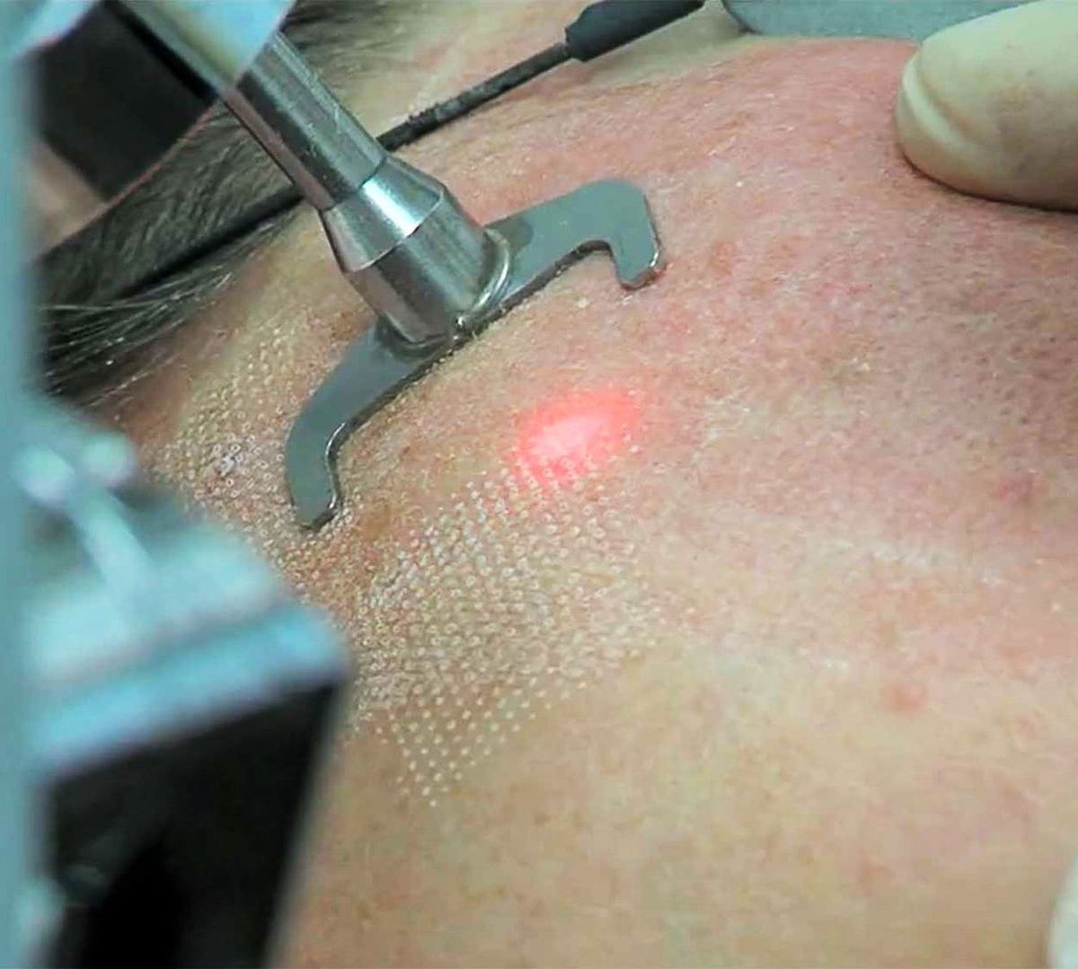A person is getting a laser treatment on their shoulder.