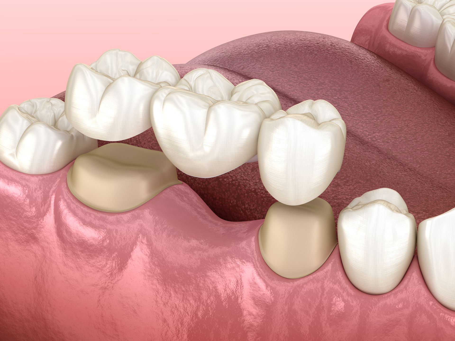 A computer generated image of a dental bridge being placed on a tooth.