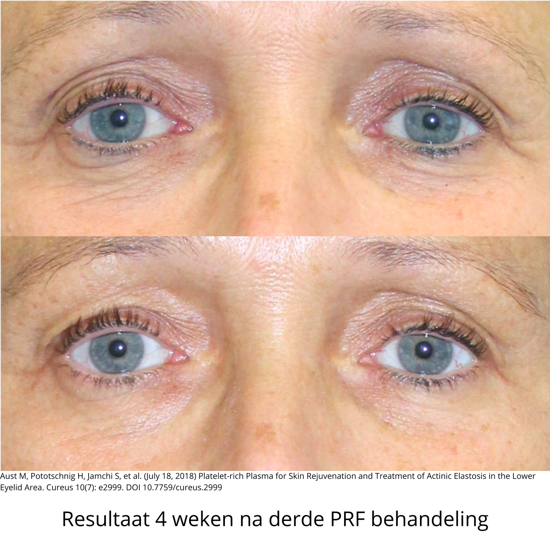 Close-up van de ogen voor en na, waarop het resultaat van de PRF behandeling zichtbaar is