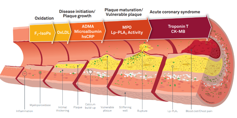 Cross-section of an artery showing atherosclerosis progression from plaque initiation to rupture and acute syndrome.