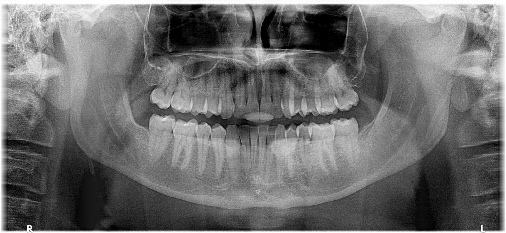 Retainers - Grand Rapids, MI - Beltline Family Dentistry Retainers - Grand Rapids, MI - Beltline Family Dentistry