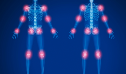 A skeleton and joints of a person with arthritis.