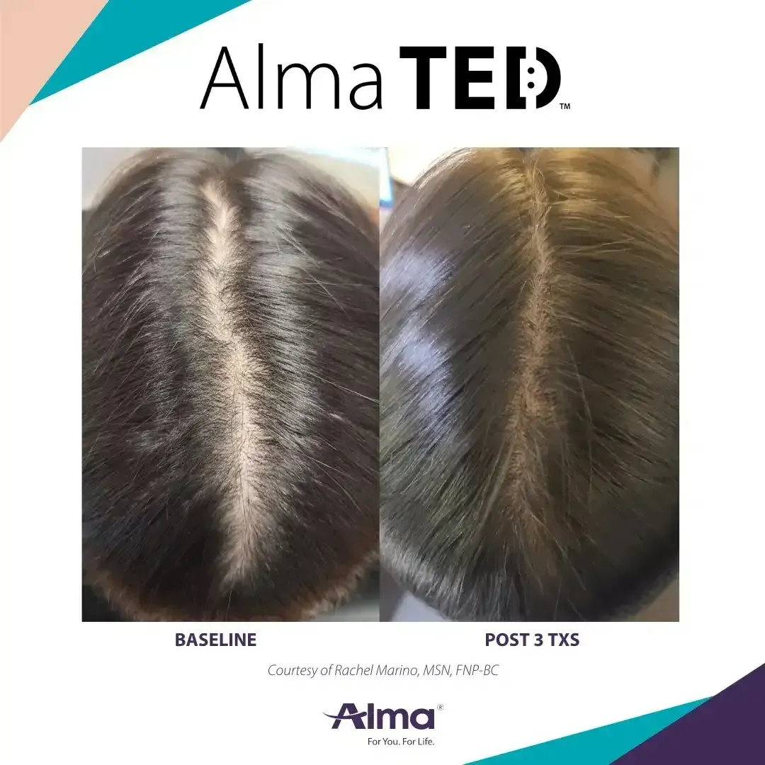 A picture of a woman 's hair before and after alma ted