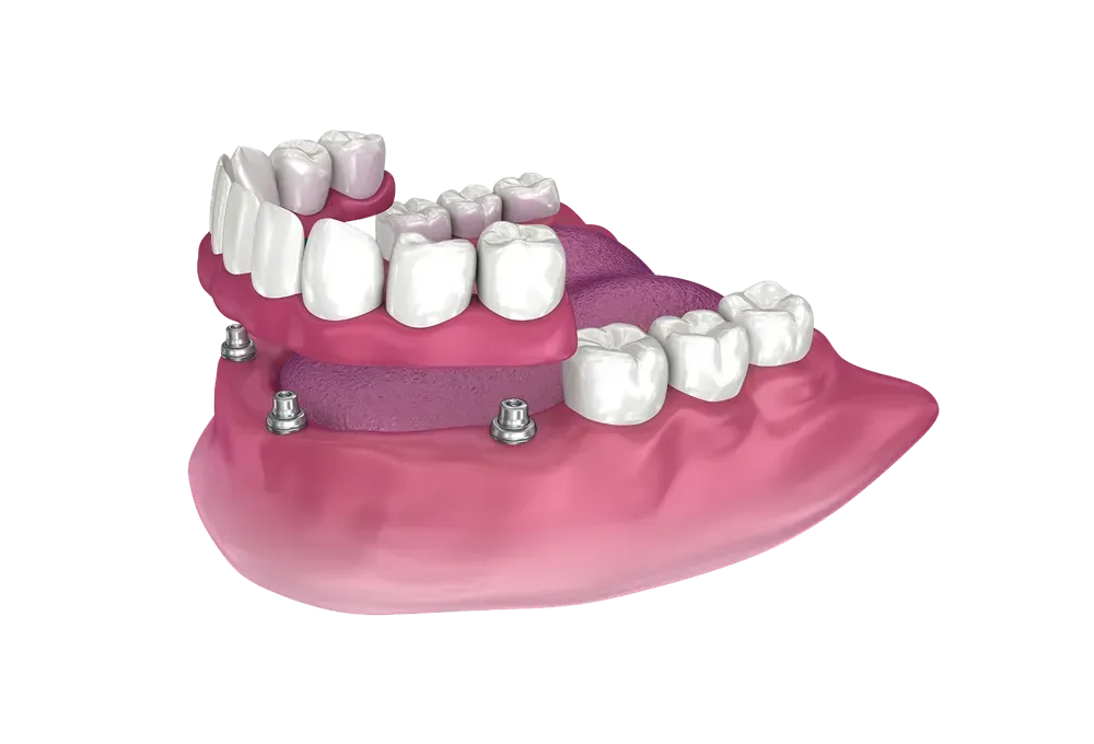 Dental Implants in Saint Bonifacius, MN