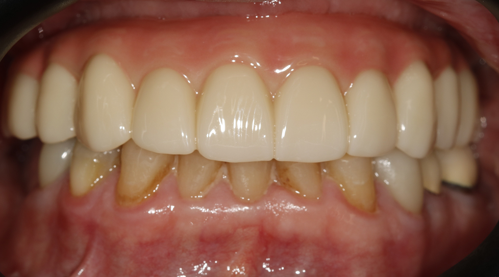 Close-up of teeth and gums, showing upper and lower front teeth with yellowing near the gumline.
