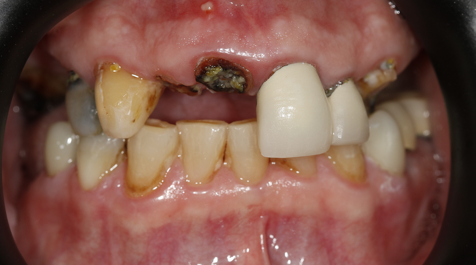 Close-up of severely decayed upper teeth with gaps and dark plaque in the mouth