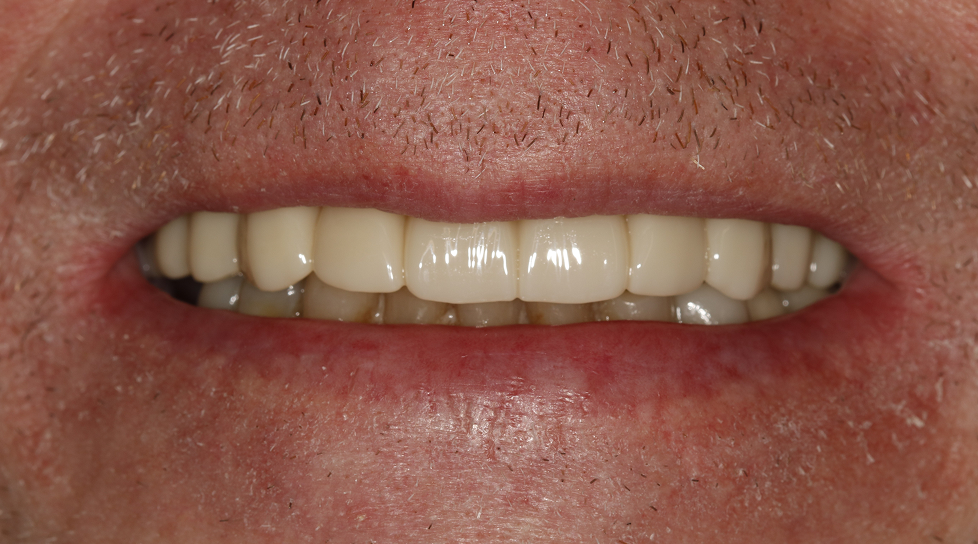 Close-up of a person’s mouth with a slight smile, showing teeth
