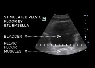 Ultrasound image showing strengthened pelvic floor muscles after Emsella treatment in Boca Raton, FL
