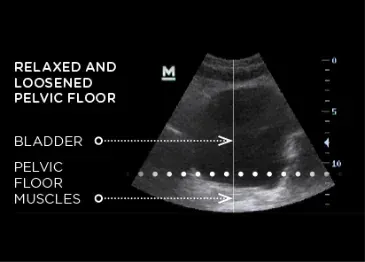 Ultrasound image showing relaxed and loosened pelvic floor muscles before Emsella treatment in Boca Raton