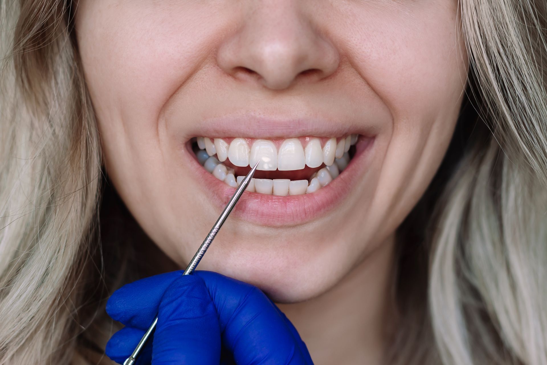 Woman with white spots on front teeth