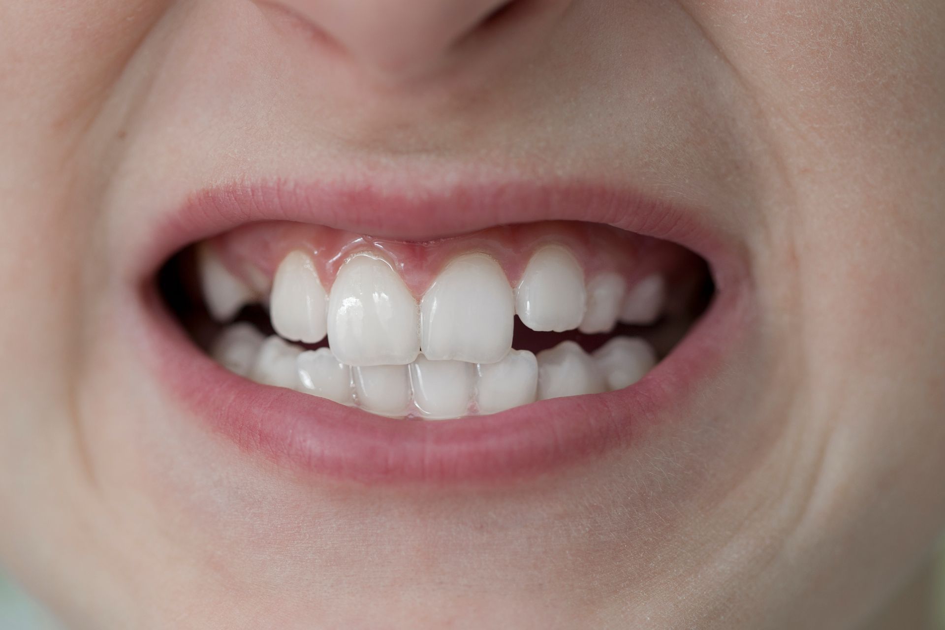 child with crooked teeth