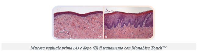 Schema di una sezione trasversale di tessuto intestinale infiammato con un'ulcera di colore rosso scuro sulla superficie della mucosa.