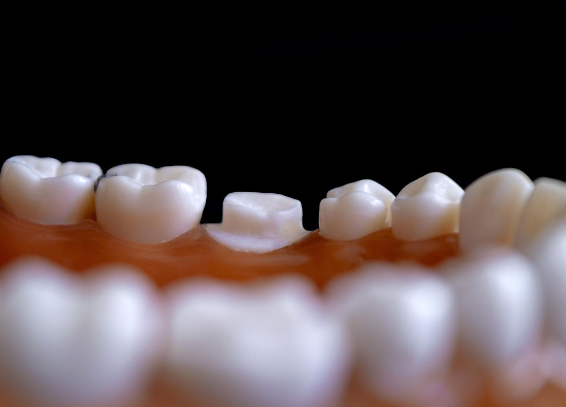 Close-up of white dental crowns on a gum-colored model with blurred teeth in the foreground