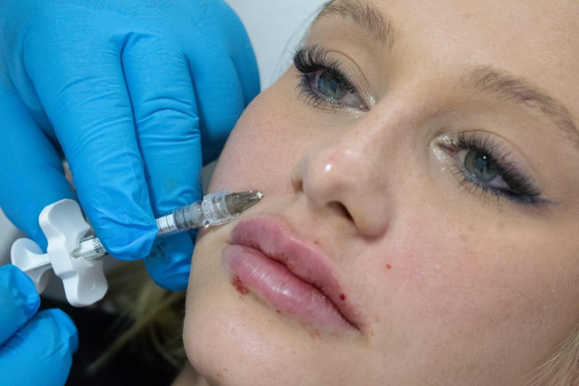 Primer plano de una mano enguantada inyectando relleno en el labio superior de un paciente con una jeringa.