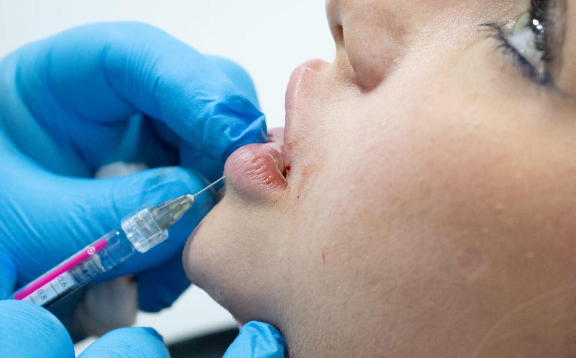 Primer plano de un profesional médico con guantes azules inyectando relleno dérmico en el labio de una persona con una aguja.