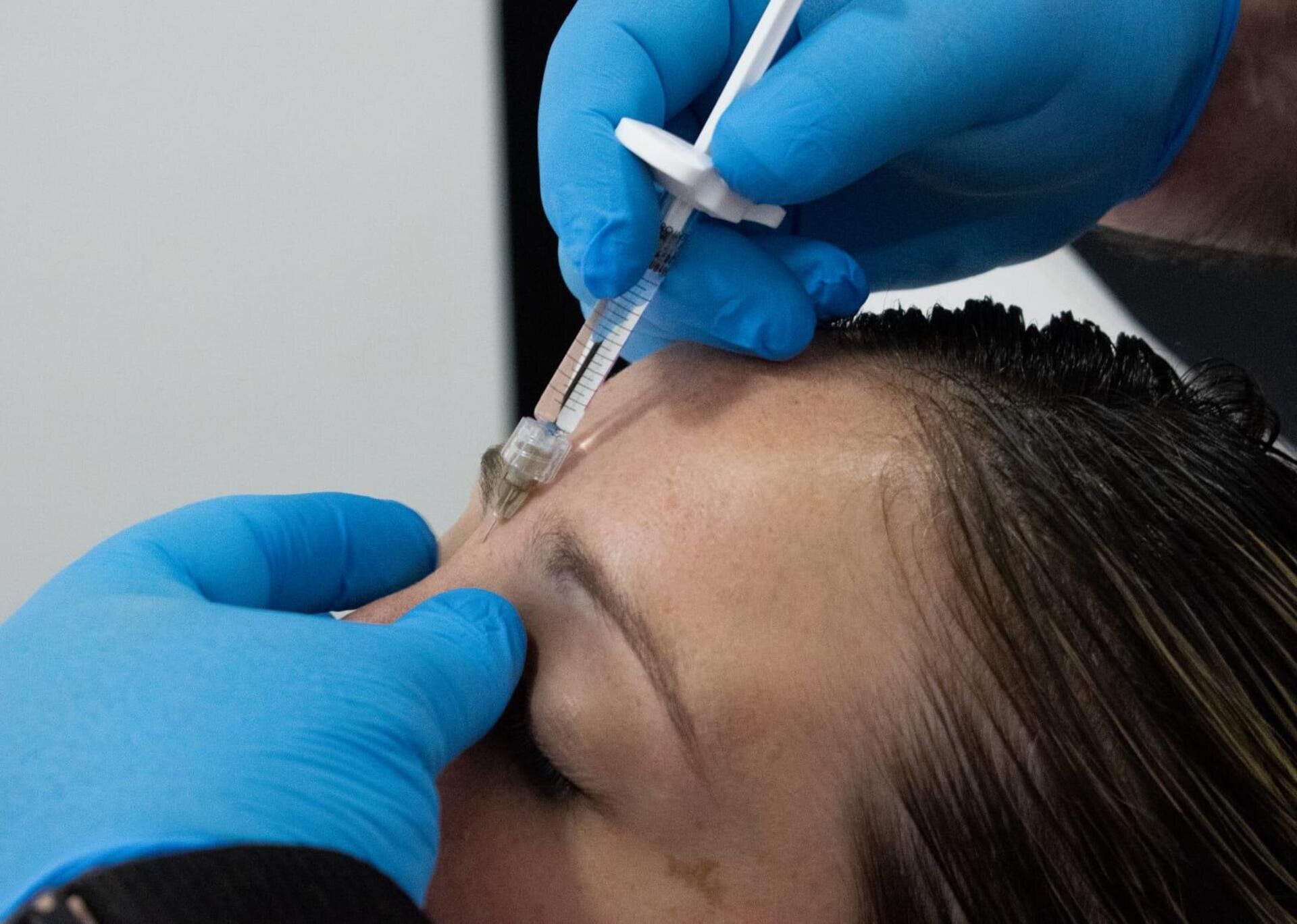 Una mano enguantada administra una inyección facial en la frente de un paciente.