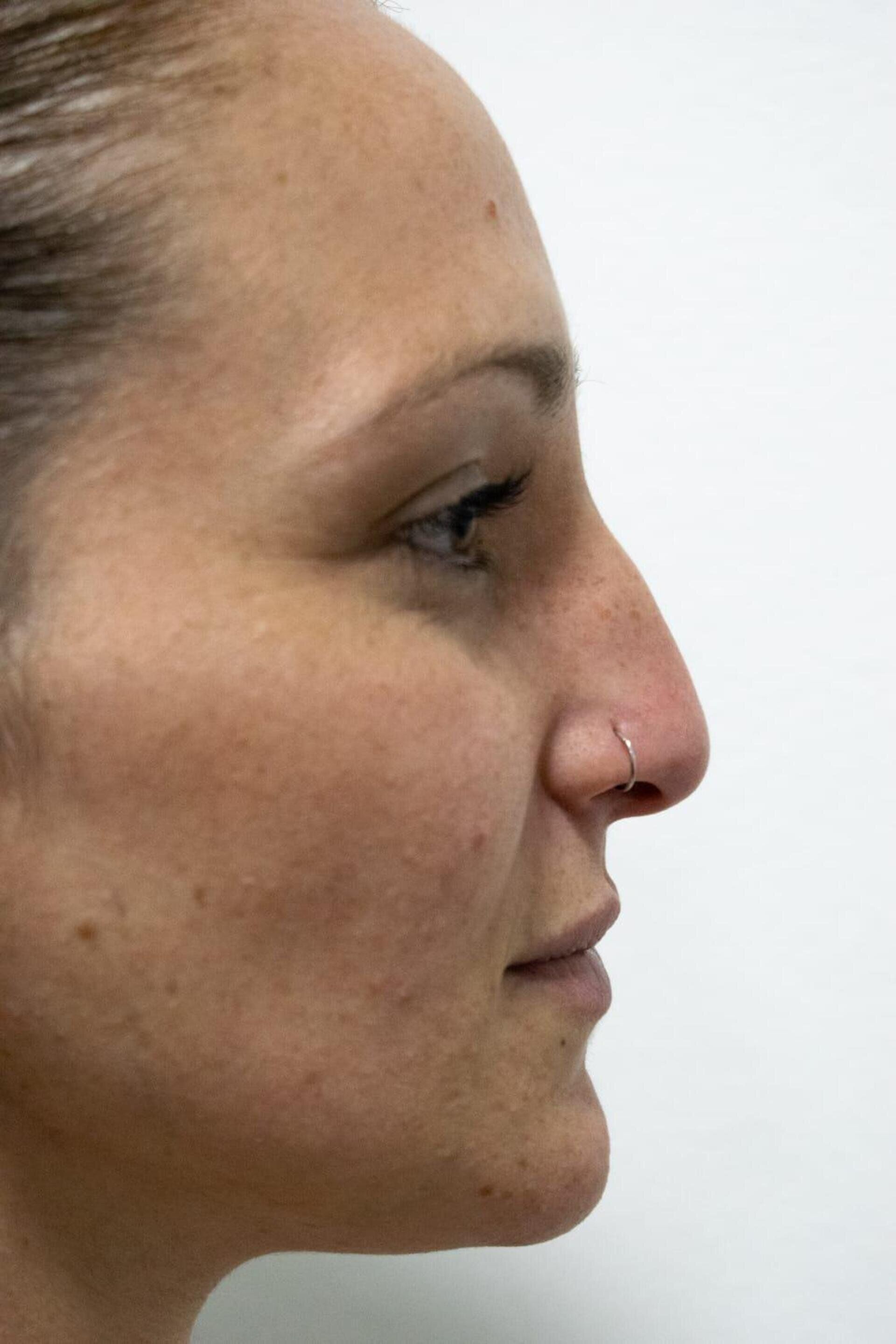 Vista de perfil del rostro de una persona, destacando su nariz, que luce un pequeño
