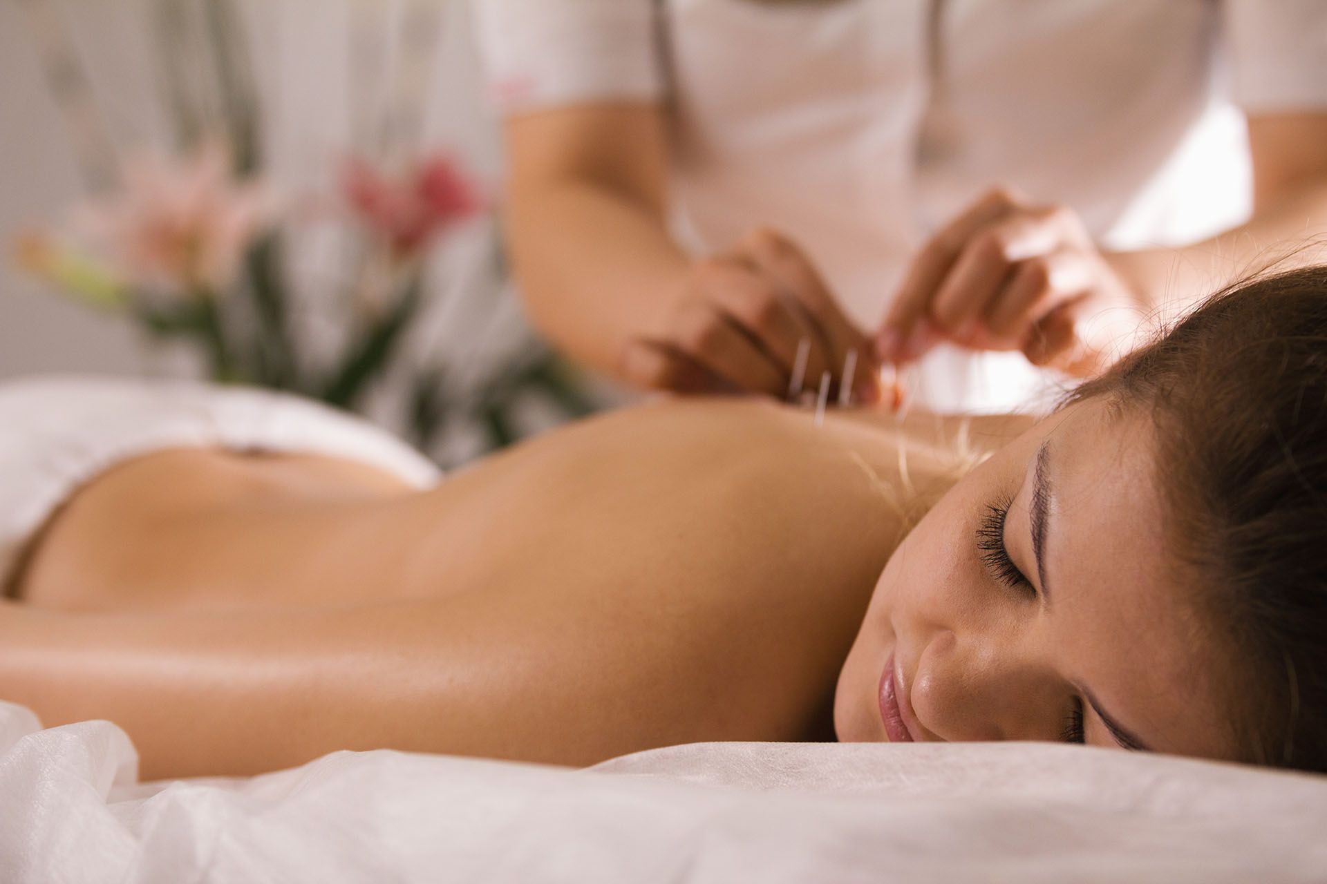 Close-up of a woman receiving an acupuncture treatment in her back. Close-up of a woman receiving an acupuncture treatment in her back.