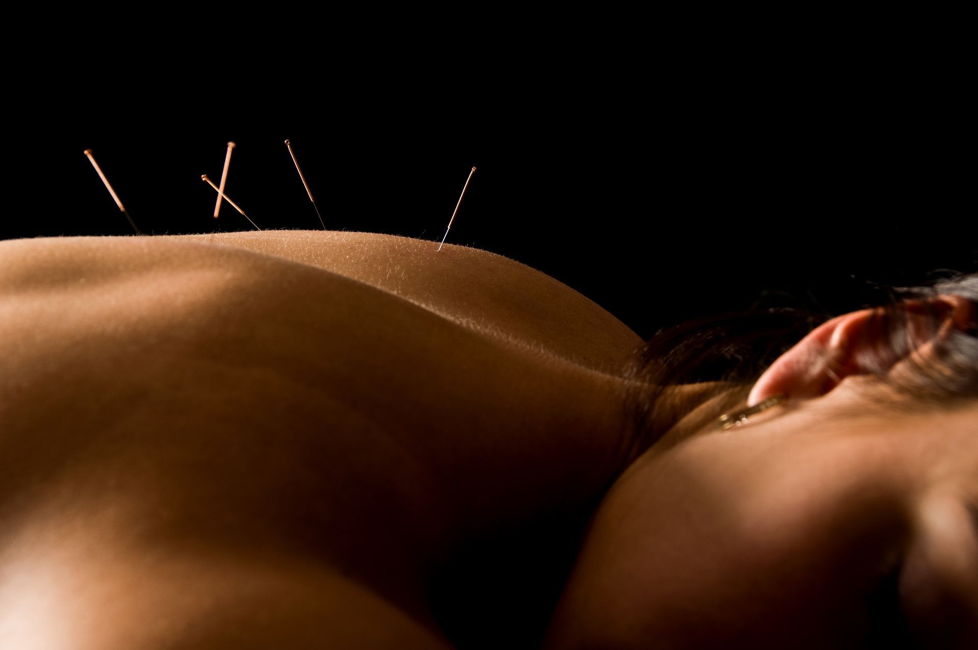 Acupuncture needles placed along a patient’s upper back during a treatment session.