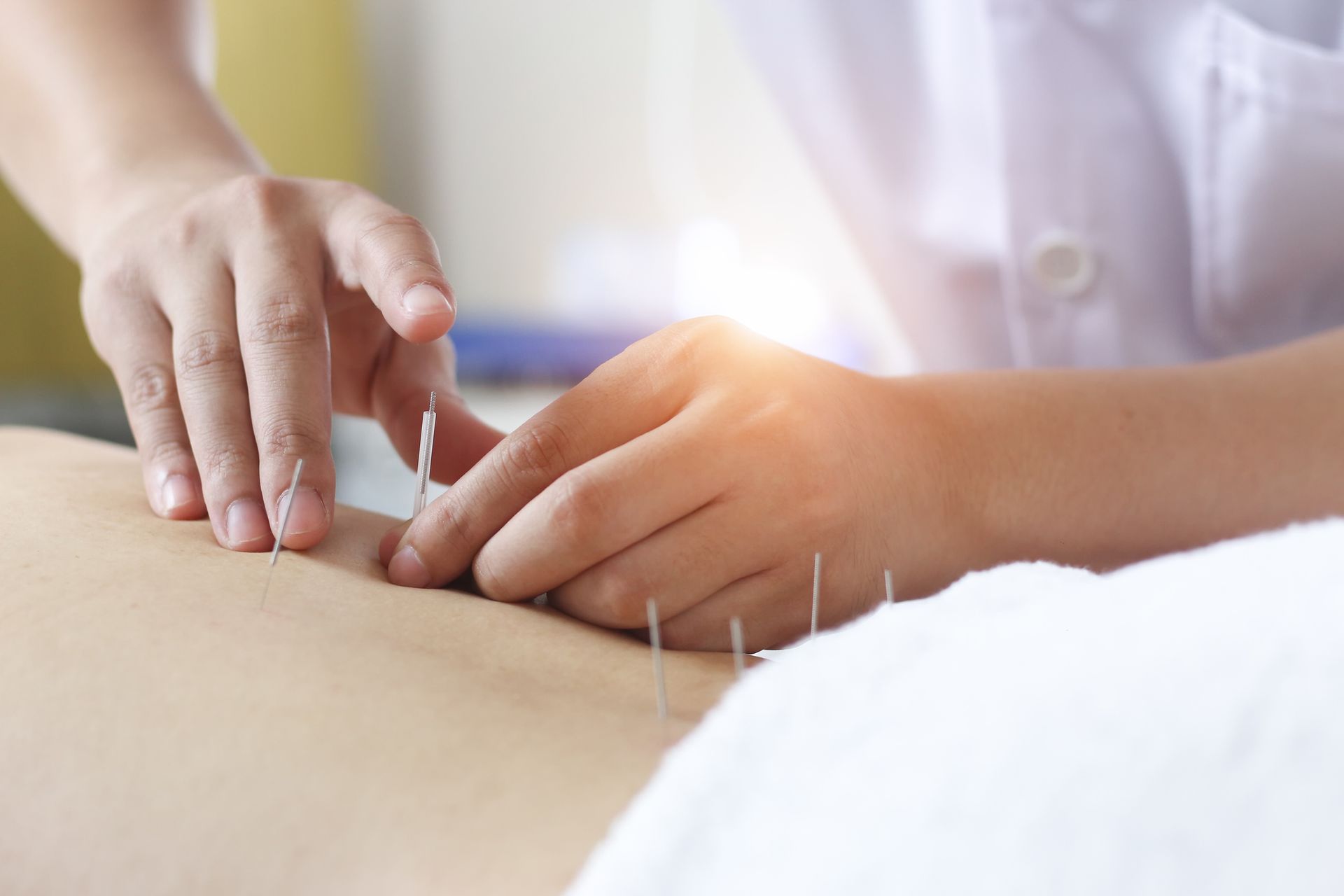 Close-up of an acupuncture therapy session for natural pain relief.