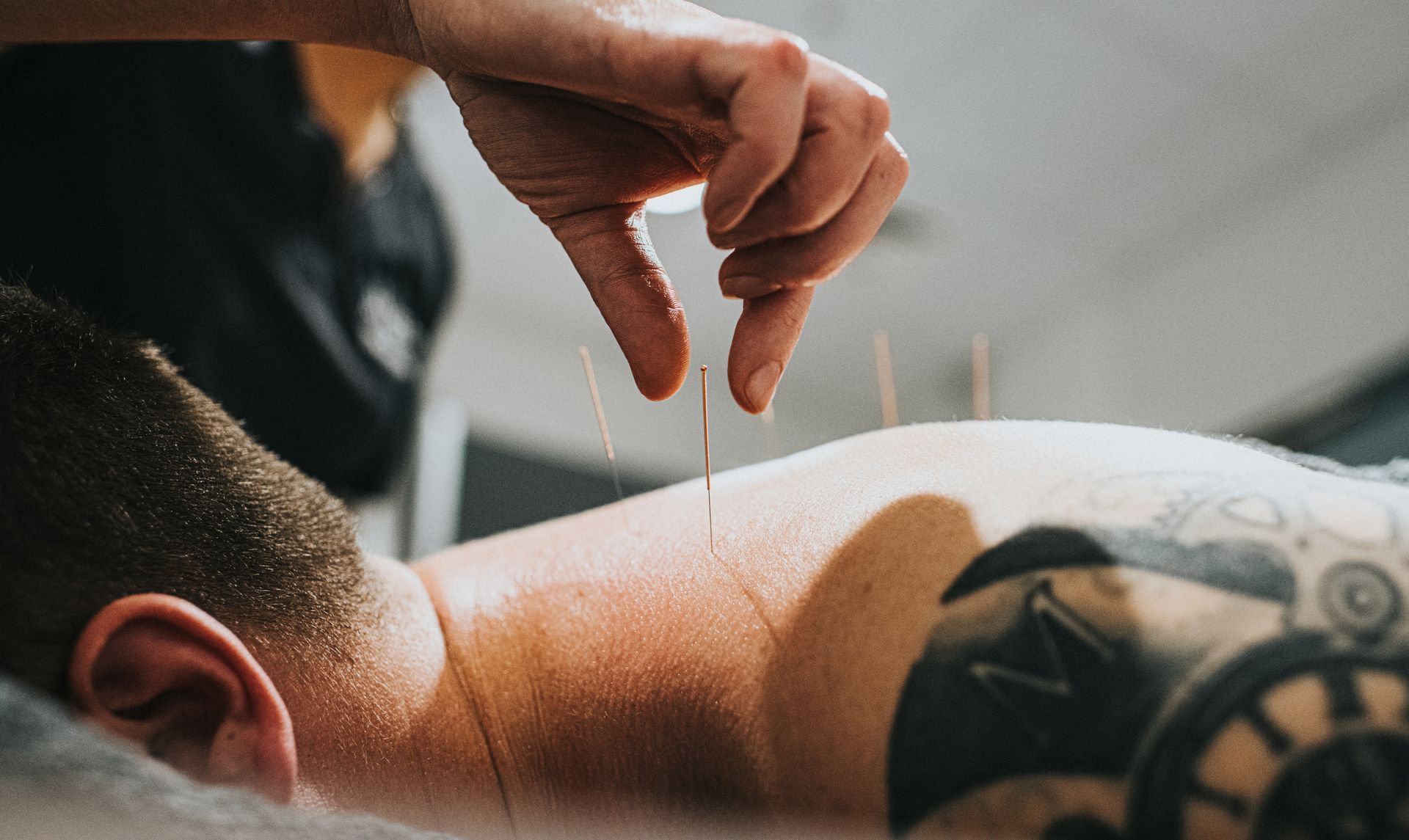 Man lies face down on a massage table while a professional places an acupuncture needle in his back.