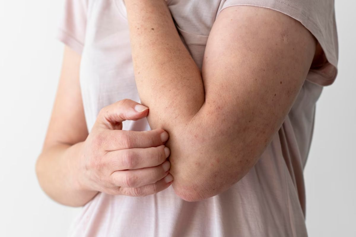 eczema