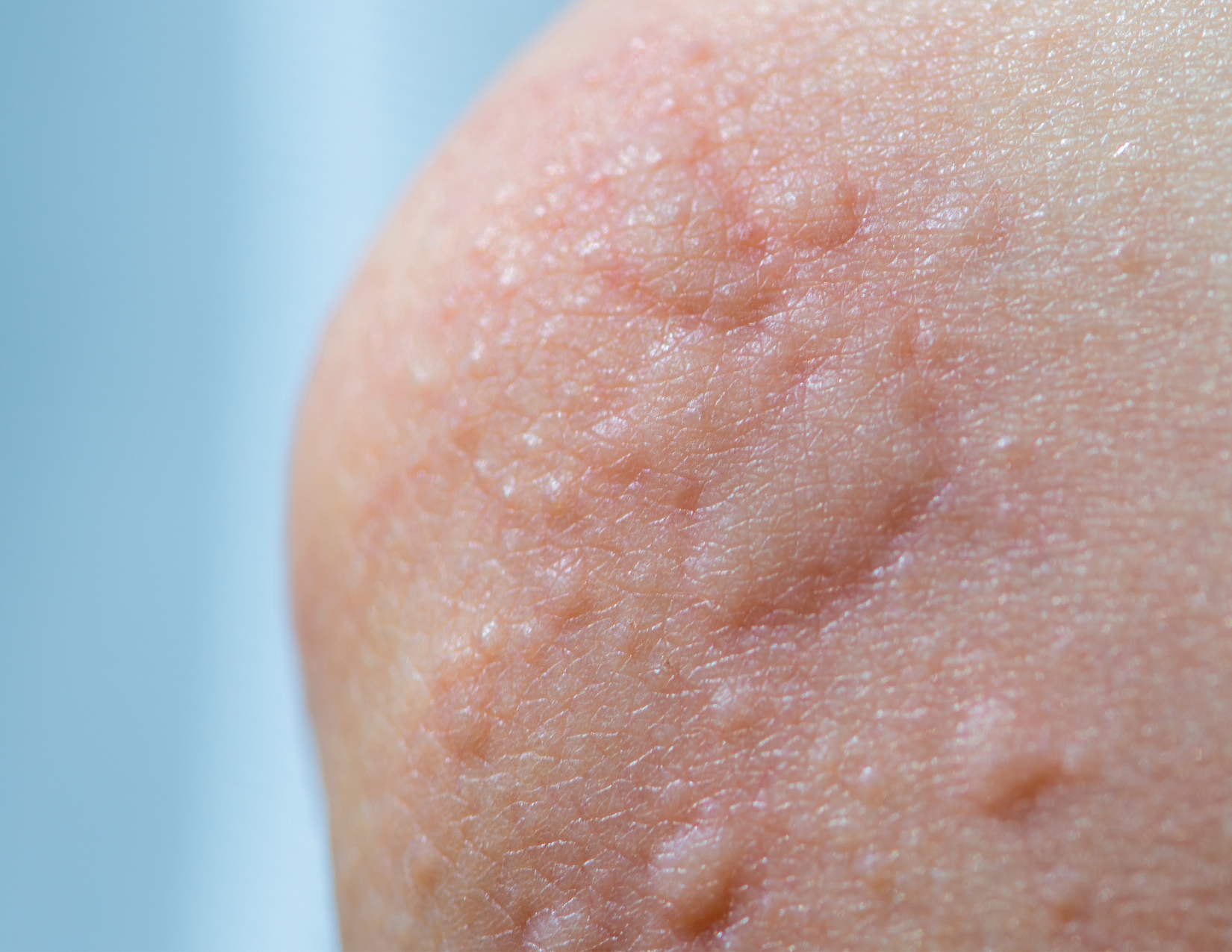 hives
