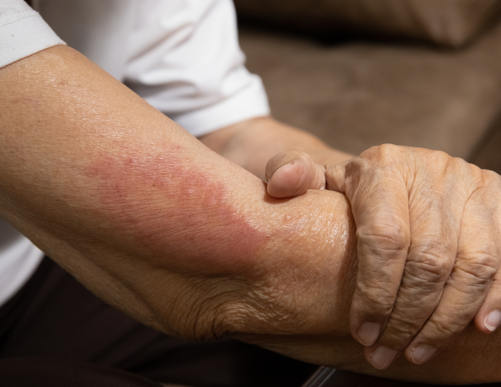contact dermatitis