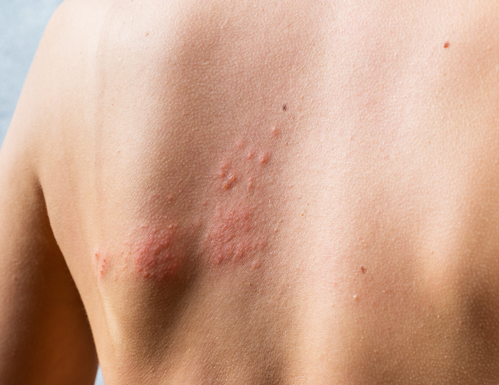 urticaria