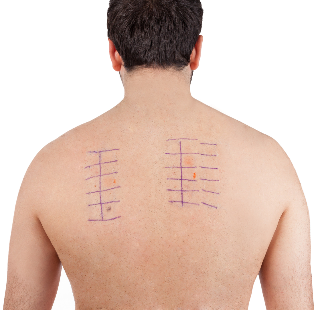 patch tests