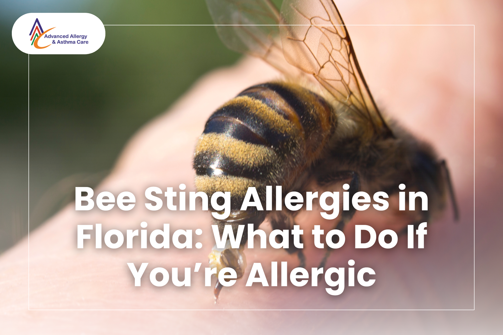 A bee is about to sting a person’s hand, potentially causing a bee sting allergy reaction.