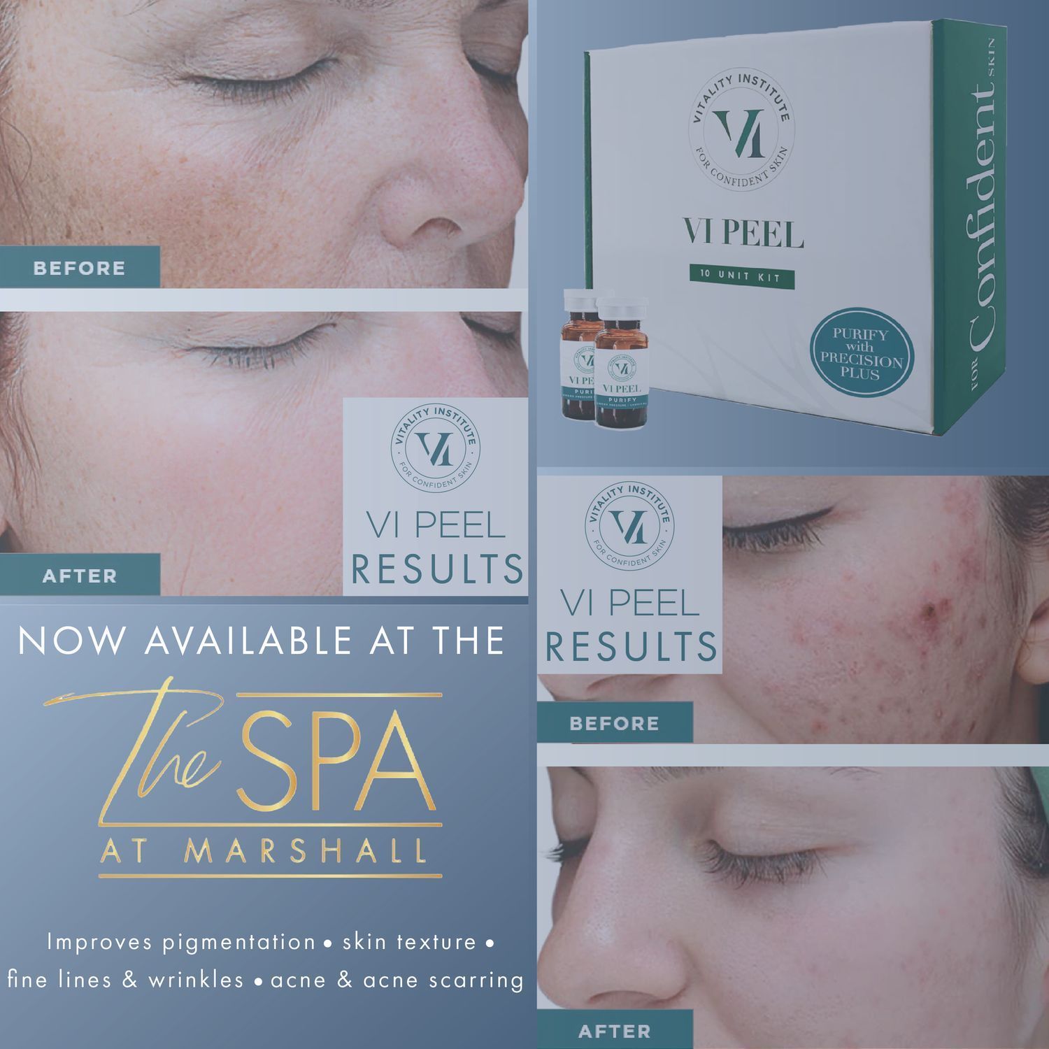 VI Medium-Strength Peel
