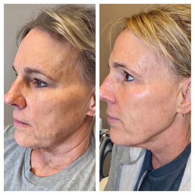 Side-by-side profile photos of a woman before and after treatment, showing dermal filler facial changes.