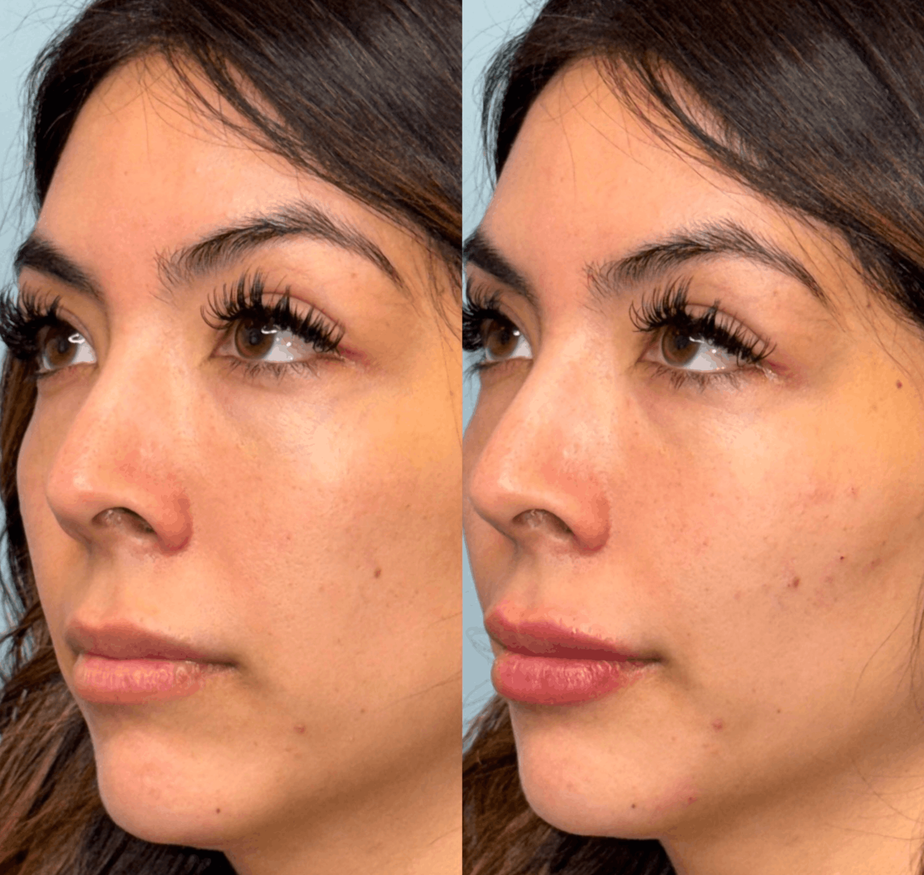 Side-by-side facial profile close-ups of a woman, showing a before-and-after comparison with smoother lips and skin on the right