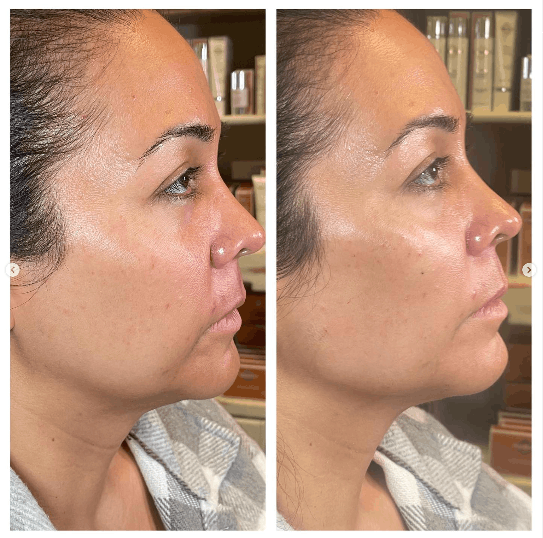 Side-by-side profile views of a woman’s face before and after cosmetic treatment, with reduced nasal swelling on the right.