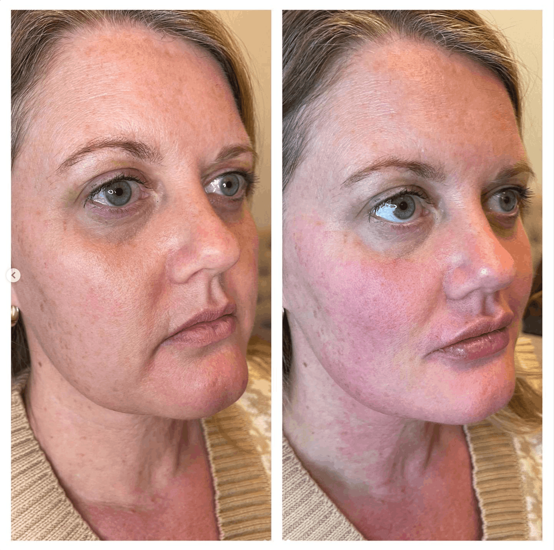 Side-by-side facial photos of the same woman, showing before and after cosmetic treatment.
