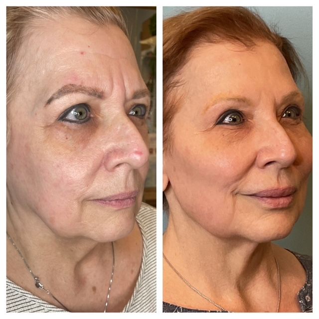 Side-by-side facial profile photos showing before and after dermal filler at Collins Vitality