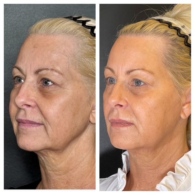 Side-by-side facial profile photos showing before and after skin treatment with a smoother, brighter complexion