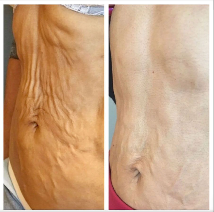 Side-by-side torso photos showing loose abdominal skin on the left and smoother skin on the right after PDO Thread Lift