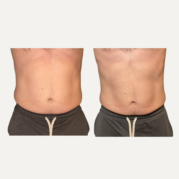Side-by-side close-up of a bare midsection before and after, showing a flatter stomach on the right.