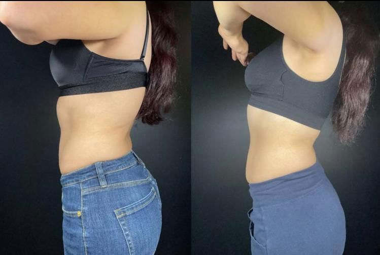 Side-by-side torso photos showing a slimmer waist in jeans and a black top, before and after comparison