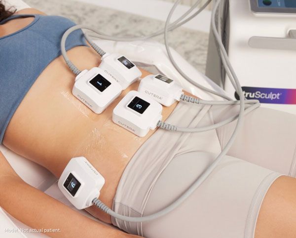 Torso with four white body-contouring treatment pads attached by cords